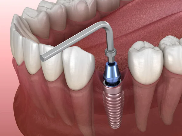 植入植入物固定程序 医学上准确的人类牙齿和假牙概念三维图像 — 图库照片
