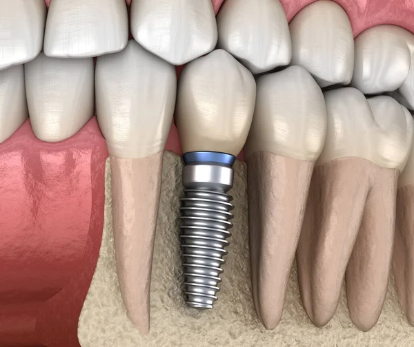 Recuperação Dentes Pré Molares Com Implante Ilustração Medicamente Precisa Conceito — Fotografia de Stock