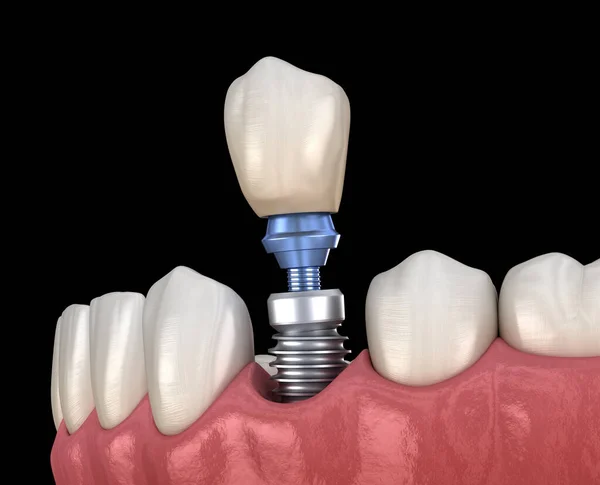 前磨牙修复植入物 医学上准确的人类牙齿和假牙概念三维图像 — 图库照片