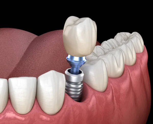 Premolární Zotavení Zubů Implantátem Lékařsky Přesná Ilustrace Konceptu Lidských Zubů — Stock fotografie