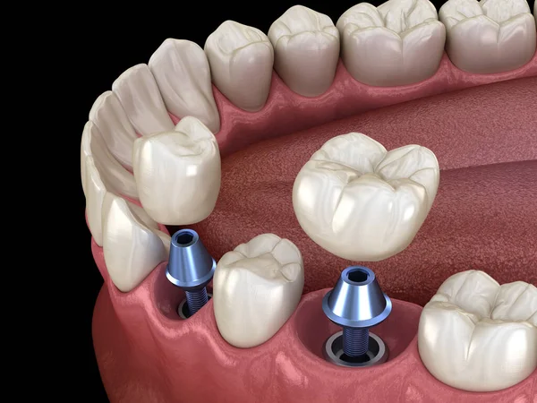 Установка Премолярной Молярной Зубной Коронки Поверх Имплантата Концепция Иллюстрация Человеческих — стоковое фото