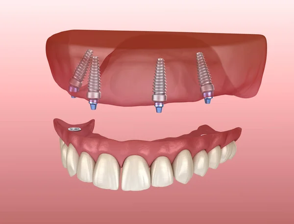 インプラントによってサポートされている4つのシステム上のすべてのガムと上顎の義肢 人間の歯と入れ歯の医学的に正確な3Dイラスト — ストック写真