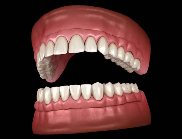 Maxillaire Mandibulaire Prothese Met Tandvlees Alles Systeem Ondersteund Door Implantaten — Stockfoto