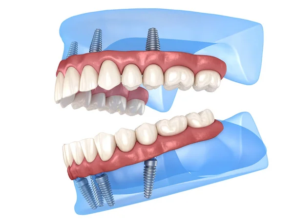 上颌骨和下颌骨假体均在4个系统上 由植入物支持 医学上准确的人类牙齿和假牙3D图像 — 图库照片