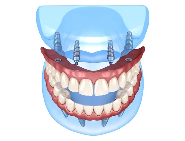 Prótese Maxilar Mandibular Com Gengiva Tudo Sobre Sistema Suportado Por — Fotografia de Stock