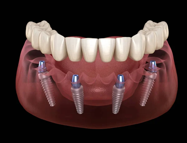 人工補綴インプラントでサポートされている4つのシステム上のすべて 人間の歯と入れ歯の概念の医学的に正確な3Dイラスト — ストック写真