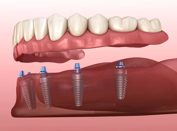 Prótesis Mandibular Con Encía Sistema All Soportado Por Implantes Ilustración — Foto de Stock