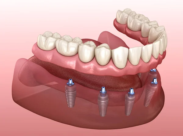 Állkapocs Protézis Rágógumival Mind Implantátummal Támogatott Rendszeren Orvosilag Pontos Illusztráció — Stock Fotó