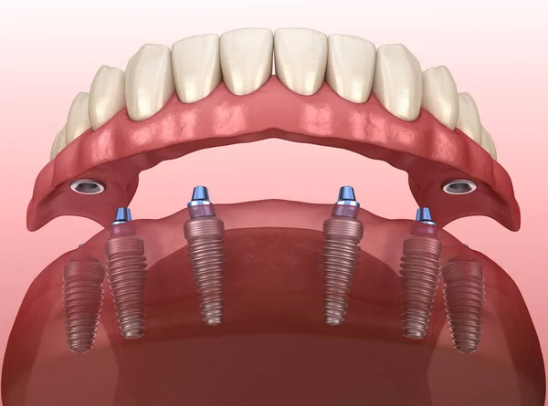 Prótesis Mandibular Con Encía Sistema All Soportado Por Implantes Ilustración — Foto de Stock