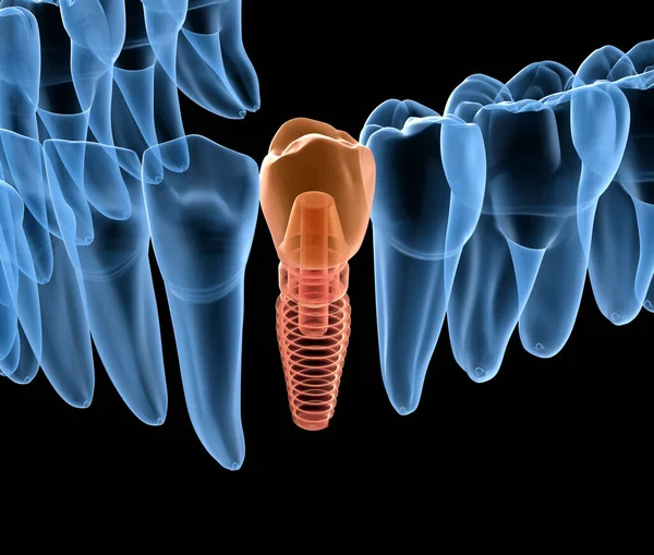 インプラント X線ビューが付いている前臼歯の回復 人間の歯と入れ歯の概念の医学的に正確な3Dイラスト — ストック写真