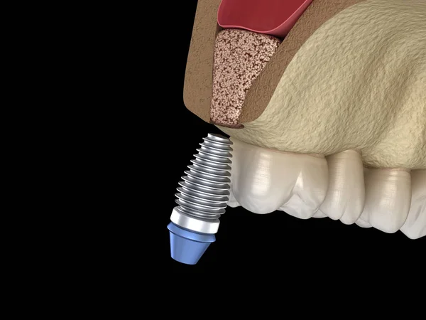 Cirurgia Elevação Sinusal Instalação Implante Ilustração — Fotografia de Stock