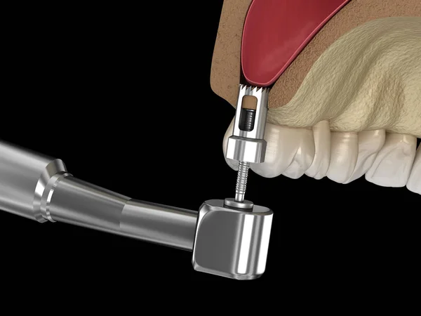 Chirurgie Des Sinus Création Accès Aux Sinus Illustration — Photo