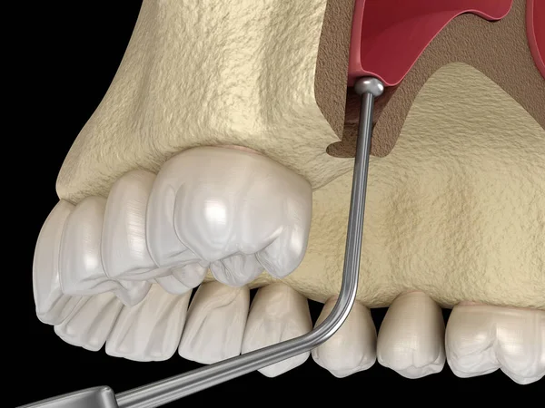 Sinus Lift Surgery Verschieben Der Sinusmembran Illustration — Stockfoto