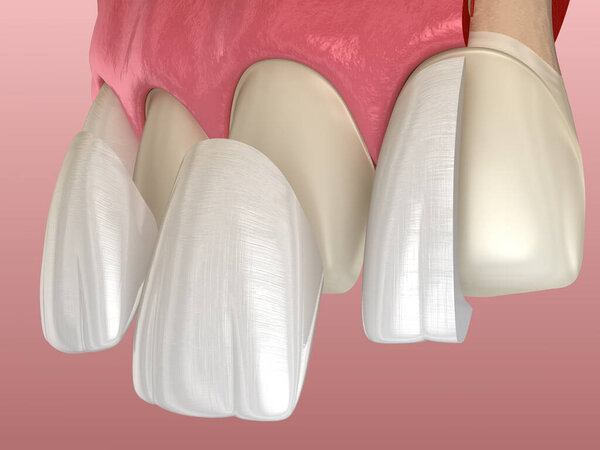 Veneer installation procedure over central incisor and lateral incisor. Sliced view, 3D illustration