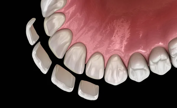 Procedimento Instalação Folheado Sobre Incisivo Central Incisivo Lateral Ilustração Dente — Fotografia de Stock