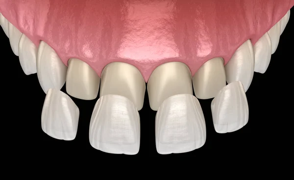 Procedimento Instalação Folheado Sobre Incisivo Central Incisivo Lateral Ilustração Dente — Fotografia de Stock