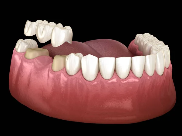 磨牙和前磨牙上有3颗牙齿的牙桥 医学上准确的人类牙齿治疗三维图像 — 图库照片