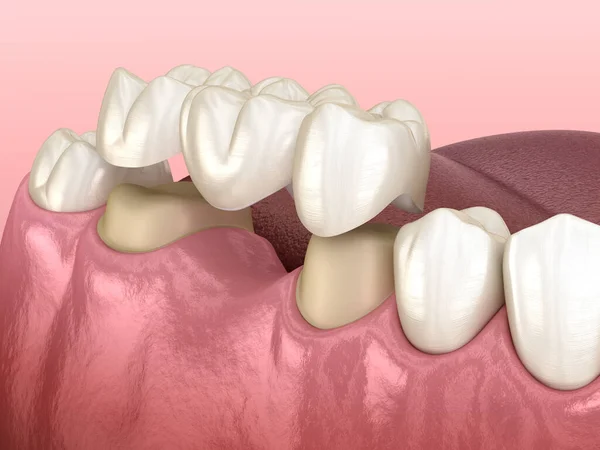 Dental bridge of 3 teeth over molar and premolar. Medically accurate 3D illustration of human teeth treatment