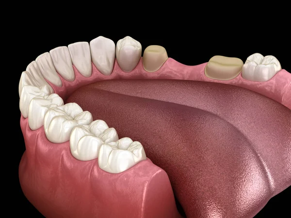 歯科橋の配置のための準備臼歯と前臼歯 医学的に正確な3Dイラスト — ストック写真