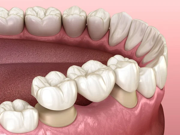 Ponte Dentale Denti Sopra Molare Premolare Illustrazione Clinicamente Accurata Del — Foto Stock