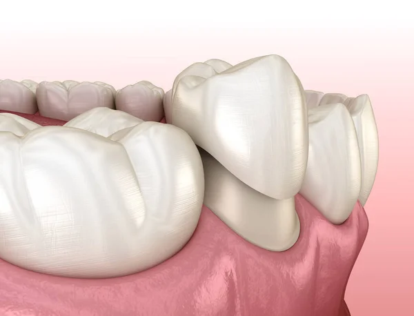 Dente Premolare Preparato Posizionamento Della Corona Dentale Illustrazione Clinicamente Accurata — Foto Stock