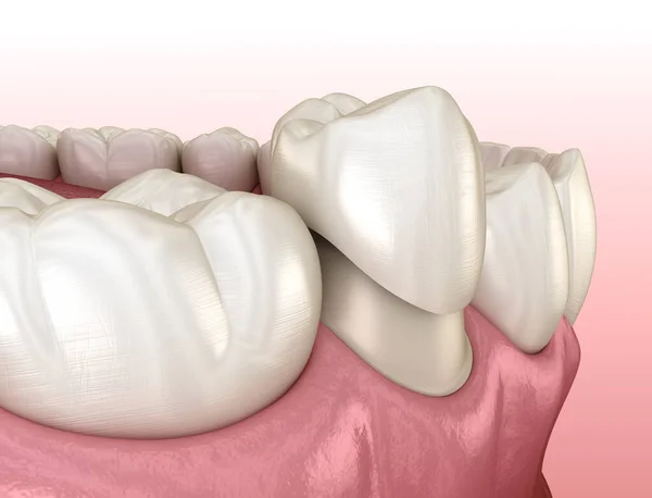 Подготовленный Премоляр Расположения Зубной Короны Медицинская Точность Иллюстрации — стоковое фото