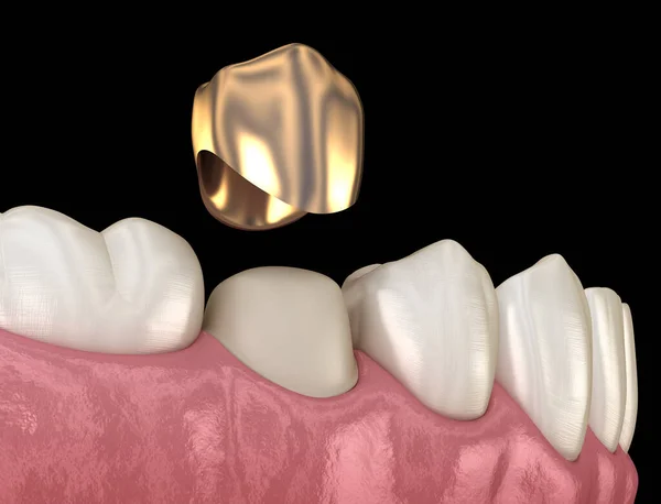 Corona Dorada Proceso Montaje Dientes Premolares Ilustración Médicamente Precisa Del —  Fotos de Stock