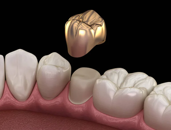Χρυσή Κορώνα Προγόμφιος Διαδικασία Συναρμολόγησης Δοντιών Ιατρικά Ακριβής Απεικόνιση Της — Φωτογραφία Αρχείου
