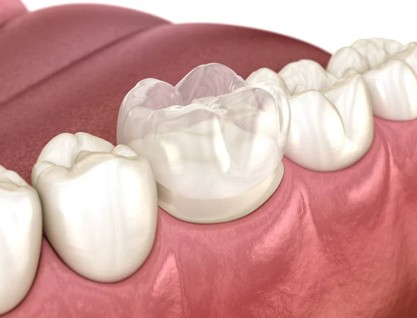 Dente Molar Preparado Para Colocação Coroa Dentária Ilustração Medicamente Precisa — Fotografia de Stock