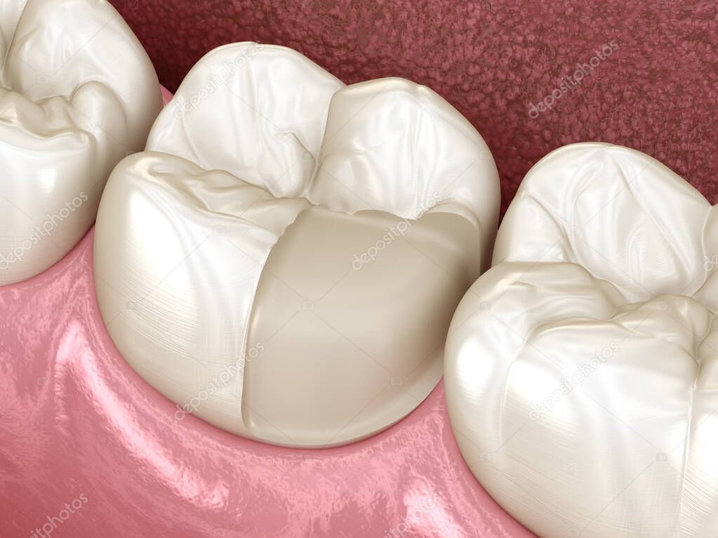 Preparation for Onlay ceramic crown fixation over tooth. Medically accurate 3D illustration of human teeth treatment