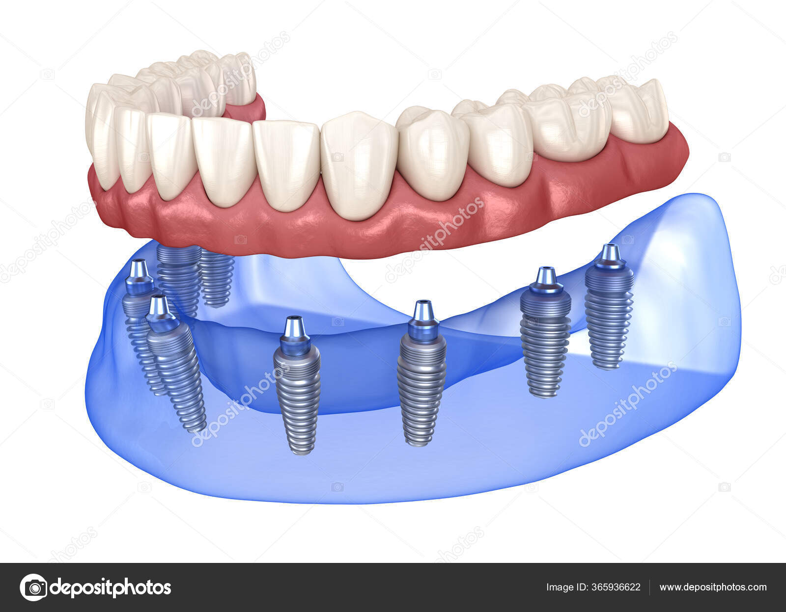 Prótese Mandibular Maxilar Tudo Sobre Sistema Suportado Por