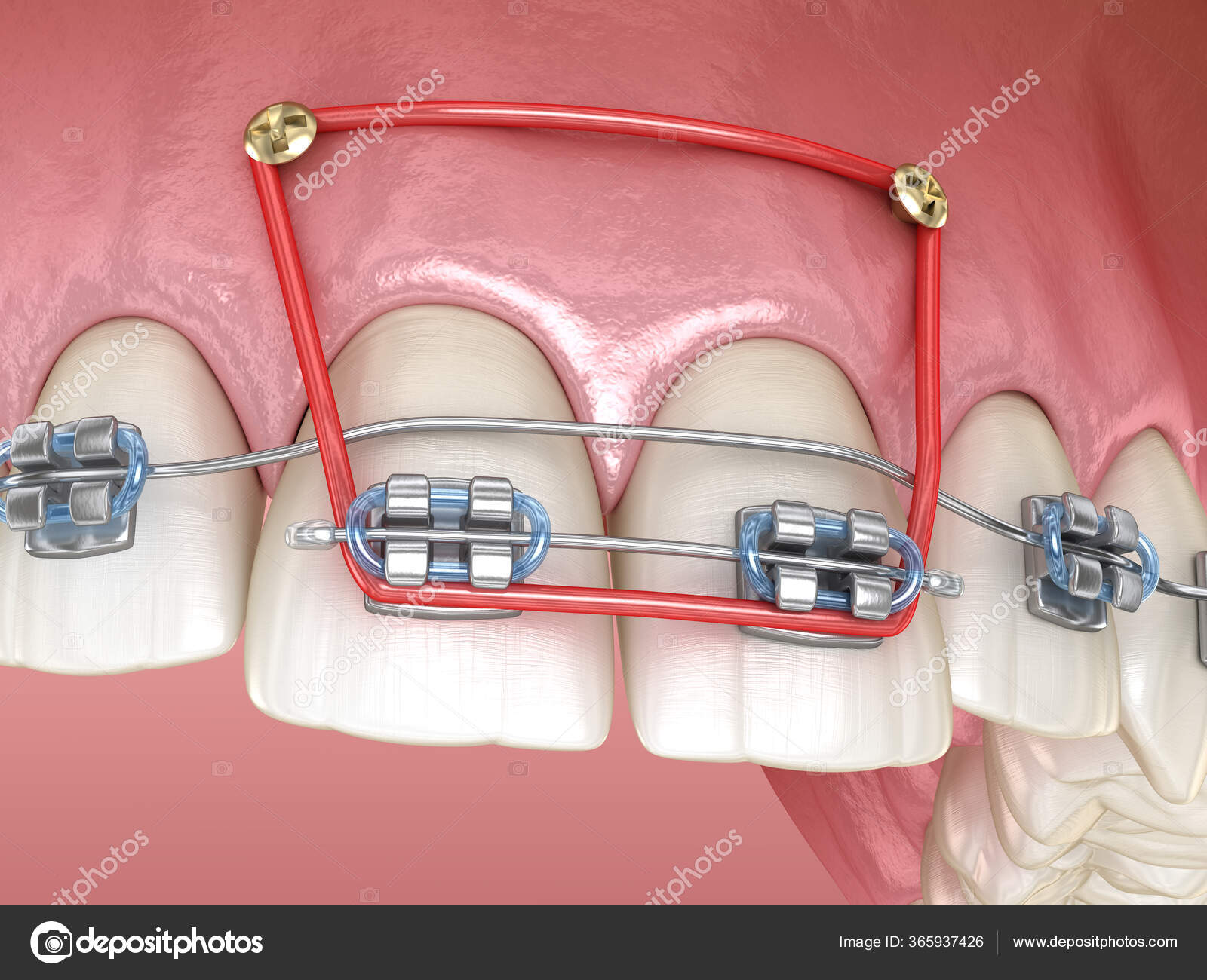 Overbite Braces Rubber Bands