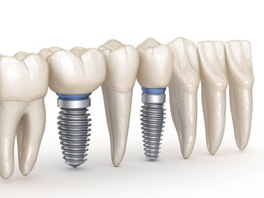 Diş implantları devrede. İnsan dişlerinin 3 boyutlu illüstrasyon kavramı.