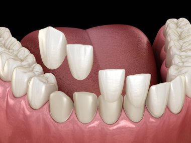 Merkezi kesici diş ve yan kesici dişler üzerinde vener kurulum prosedürü. Tıbbi olarak doğru diş 3D illüstrasyon