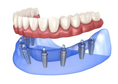 Çikletli Maxillary ve Mandibular protez. Hepsi de implantlarla desteklenen 8 sistemde. İnsan dişlerinin ve protezlerinin tıbbi açıdan doğru üç boyutlu çizimi