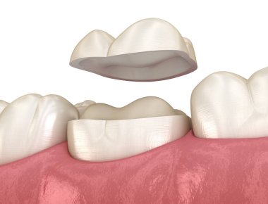 Azıdişi üzerinde onyatay seramik taç saplantısı. İnsan diş tedavisinin tıbbi açıdan doğru üç boyutlu çizimi