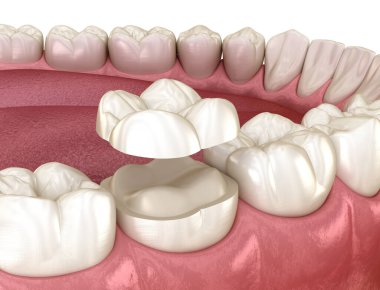 Onlay ceramic crown fixation over molar tooth. Medically accurate 3D illustration of human teeth treatment clipart