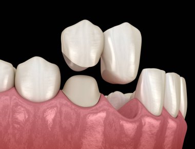 Cantilever Köprüsü, seramik ve ön dişlerden yapılmış. Diş konseptinin tıbben doğru 3 boyutlu animasyonu