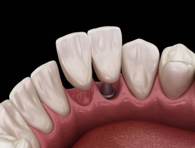 Cantilever Köprüsü implantı, ön diş tedavisi. Diş konseptinin tıbben doğru 3 boyutlu animasyonu