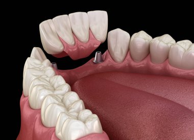 Ön diş köprüsü implantlarla destekleniyor. Diş konseptinin tıbben doğru 3D animasyonu