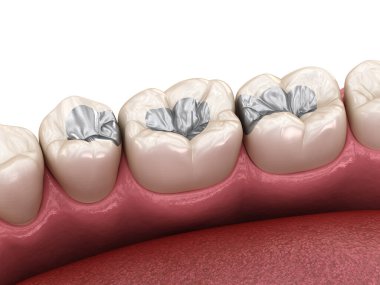 Amalgam restorasyonu. Diş konseptinin tıbben doğru 3 boyutlu animasyonu