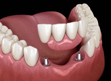 Ön diş köprüsü implantlarla destekleniyor. Diş konseptinin tıbben doğru 3D animasyonu