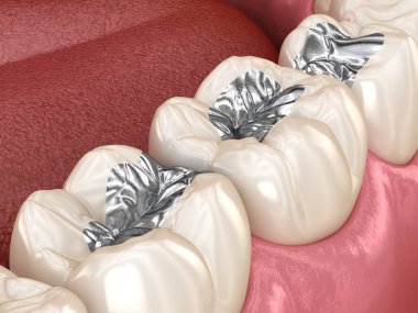 Amalgam restorasyonu. Diş konseptinin tıbben doğru 3 boyutlu animasyonu