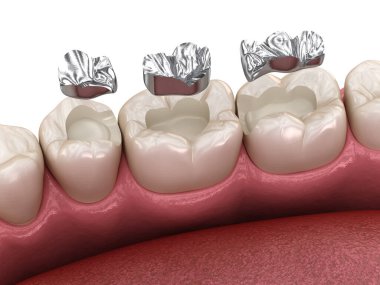 Amalgam restorasyonu. Diş konseptinin tıbben doğru 3 boyutlu animasyonu