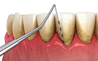 Periodontit testi, sakız resesyonu. Tıbbi olarak doğru 3B illüstrasyon