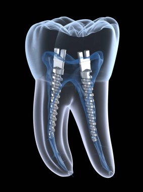 Azı dişlerinin içinde dişçi çeliği direği, röntgen görüntüsü. Diş içi endodontik tedavi 3 boyutlu illüstrasyon