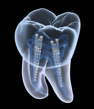 Azı dişlerinin içinde dişçi çeliği direği, röntgen görüntüsü. Diş içi endodontik tedavi 3 boyutlu illüstrasyon