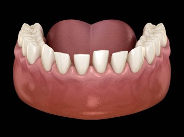 Excessive Spacing between teeth. Dental 3D illustration concept clipart