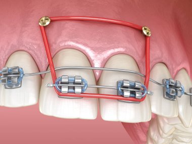 Lastik ve metal diş telleri ön kesici dişlerin dişlerini düzeltmek için. Tıbbi olarak doğru olan 3 boyutlu diş illüstrasyonu