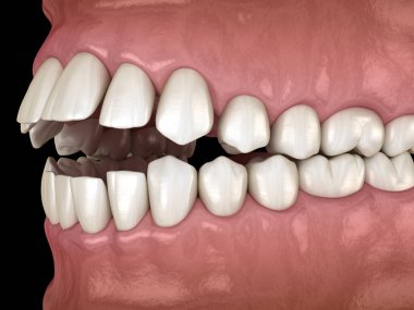 Açık diş tıkanıklığı (dişlerin Maloklüzyonu). Tıbbi olarak doğru diş 3D illüstrasyon